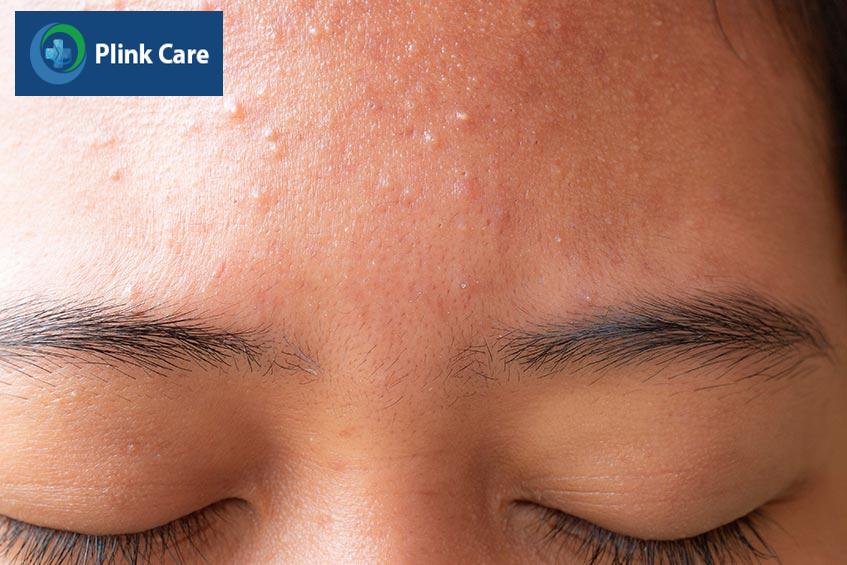 Điều trị mụn cám bằng các phương pháp dân gian không mang lại hiệu quả cao, thậm chí còn khiến tình trạng mụn cám trầm trọng hơn, gây viêm và sưng