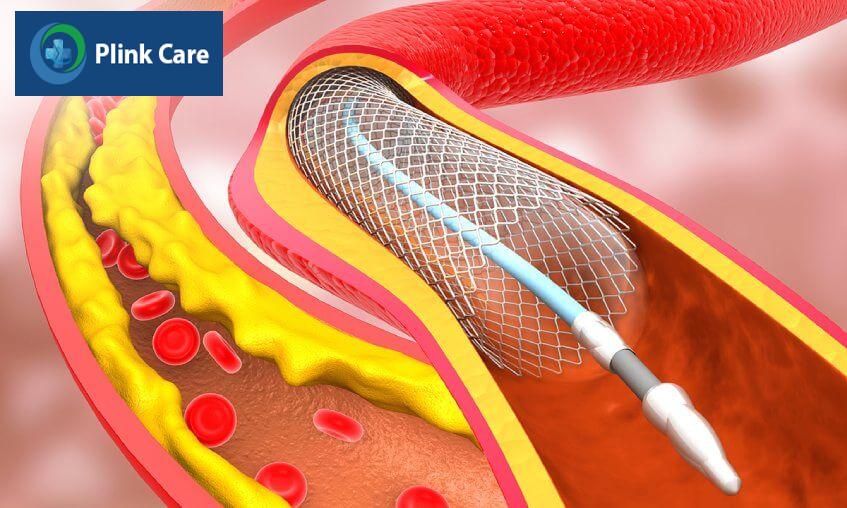 điều trị thiếu máu não ở người già