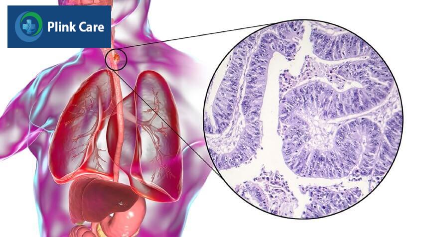 điều trị ung thư thực quản giai đoạn 0
