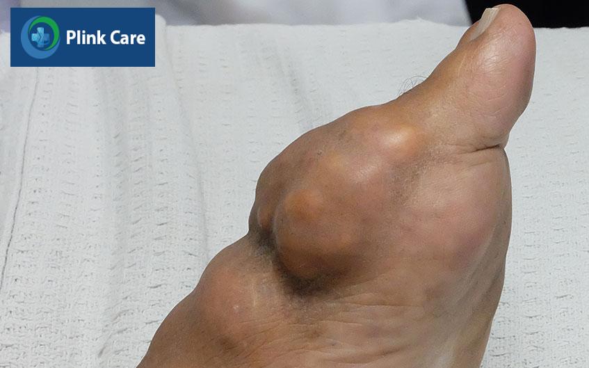 gút mạn tính gây ra biến chứng hạt tophi