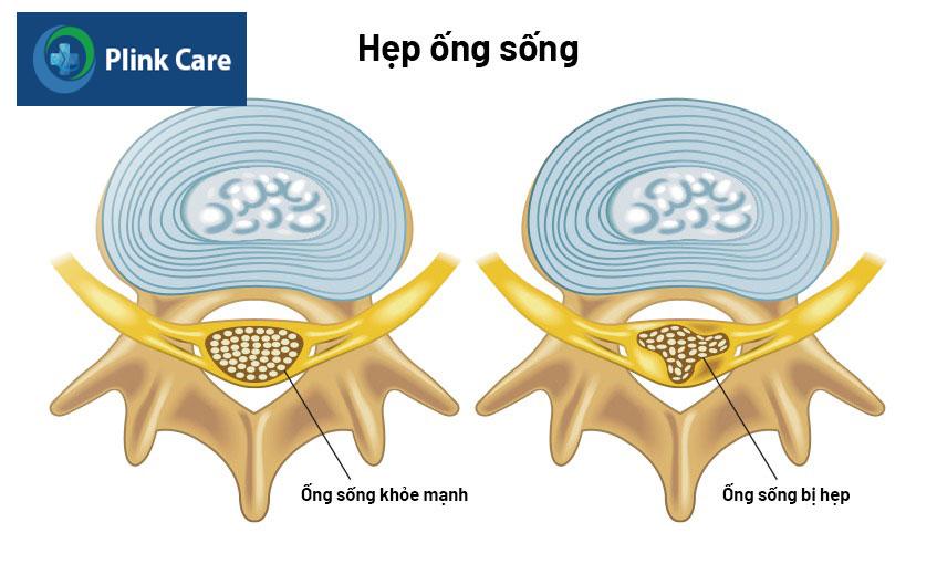 hẹp ống sống gây đau nhức ở vai