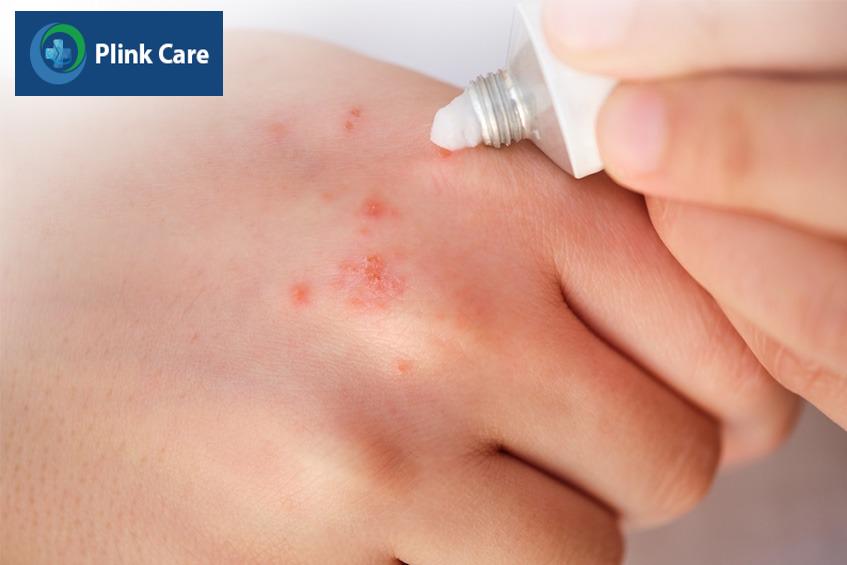 Hình ảnh kem bôi ngoài da Corticoid