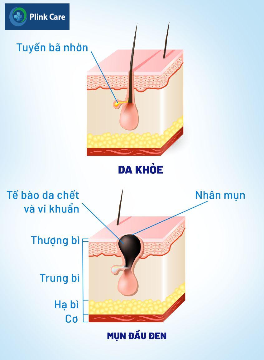 Mụn đầu đen ở mũi là những chấm đen nhỏ trên da, không sưng hoặc đau.