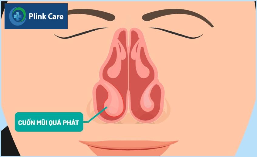hình ảnh phì đại cuốn mũi