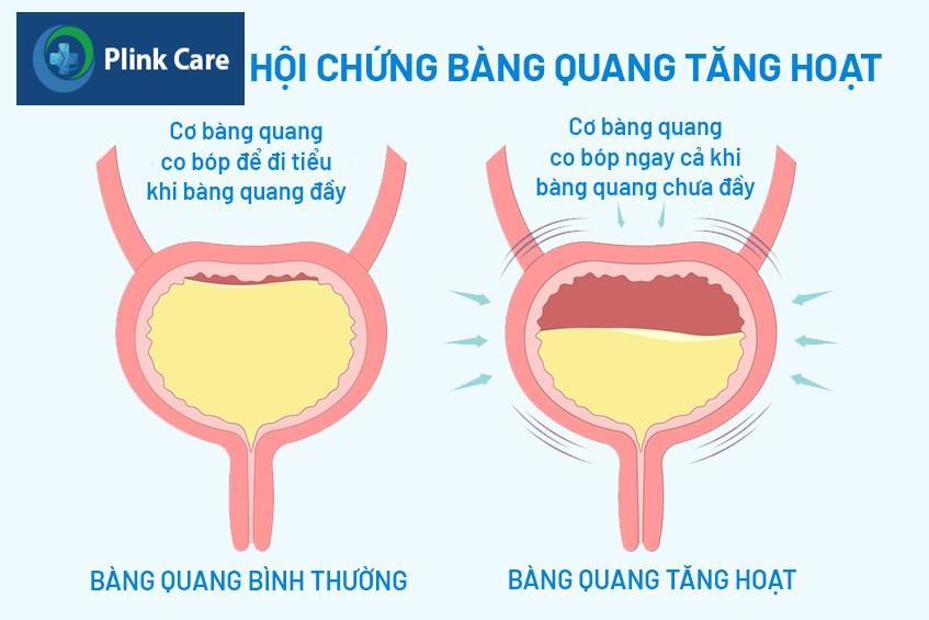Hình ảnh minh họa hội chứng bàng quang tăng hoạt