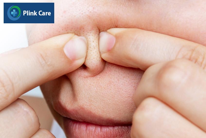 Không nên tự nặn mụn đầu đen