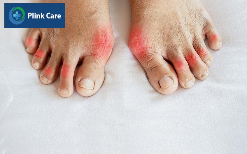 khớp ngón chân bị viêm gây cản trở hoạt động