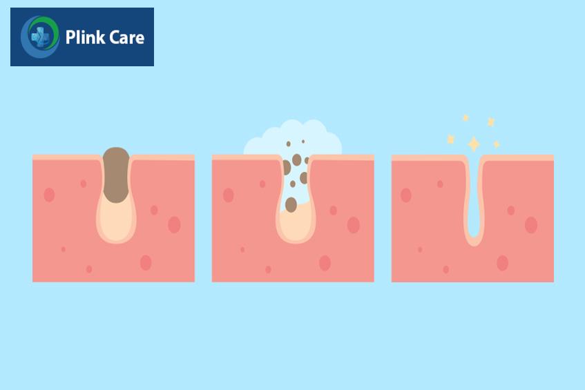 Dùng sữa rửa mặt có chứa axit salicylic đều đặn 2 lần/ngày để lỗ chân lông sạch sâu và ngăn nổi mụn đầu đen ở cằm.