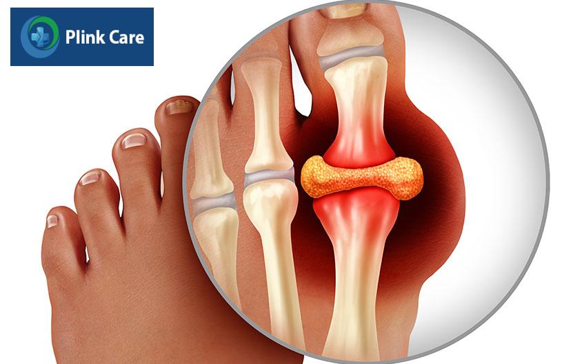 lắng đọng urat trong các khớp