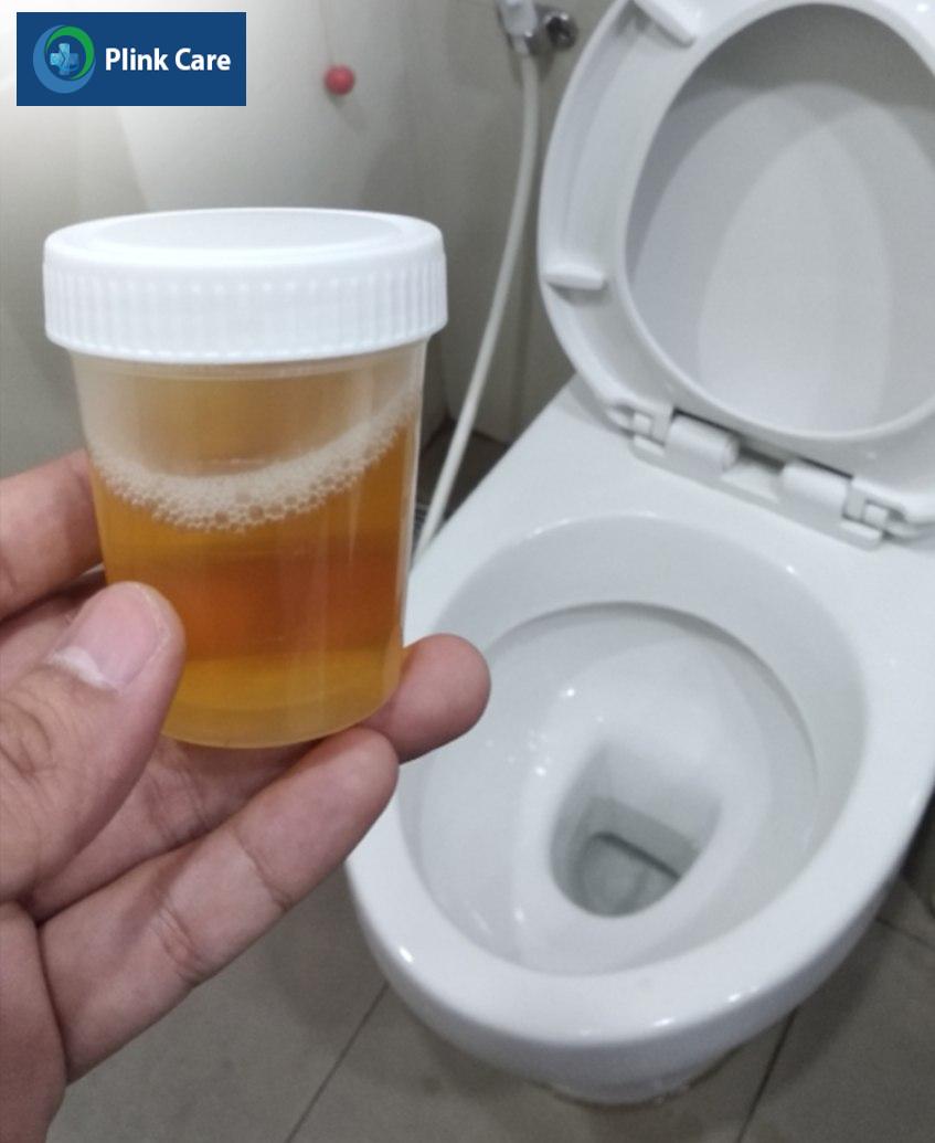 Lấy mẫu nước tiểu để xét nghiệm định lượng protein niệu