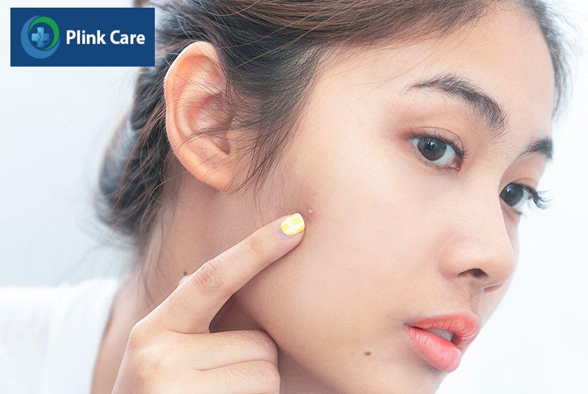 Xây dựng chế độ ăn uống lành mạnh và lối sống điều độ sẽ ngăn mụn ẩn xuất hiện.