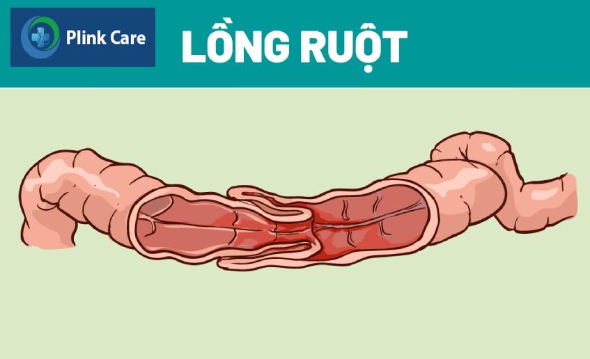 Một phần ruột bị trượt vào đoạn ruột kế bên