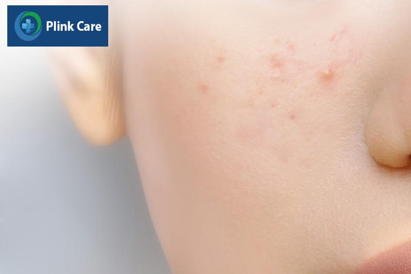 Mụn ẩn ở má không xuất hiện trên bề mặt mà nằm sâu ở lớp dưới da gây khó khăn trong việc nặn mụn và có thể để lại sẹo