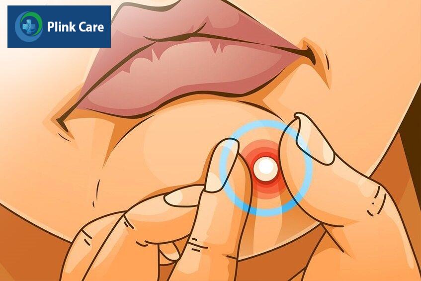 Chỉ nặn mụn khi nhân mụn gom lại và lộ rõ
