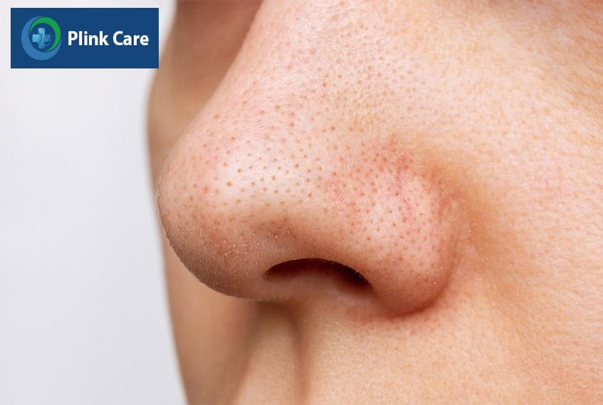 Khi mụn đầu đen hình thành cần có biện pháp xử lý càng sớm càng tốt để tránh những hậu quả xấu cho làn da trong tương lai