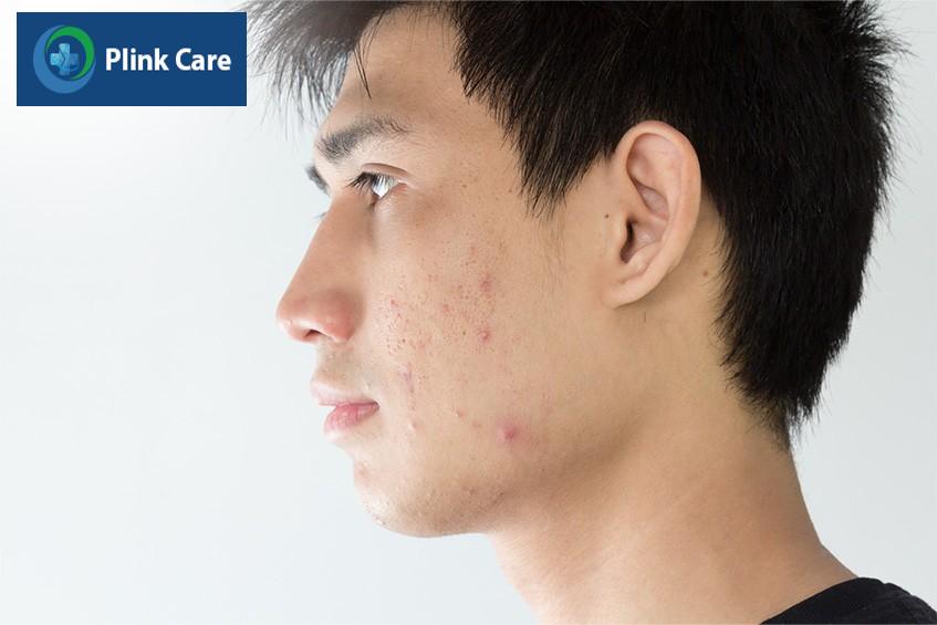 Mụn nội tiết ở nam không điều trị khiến da thâm và sẹo