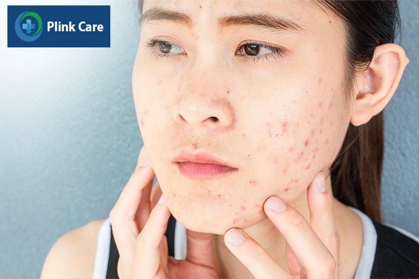 Mụn nội tiết ở phụ nữ