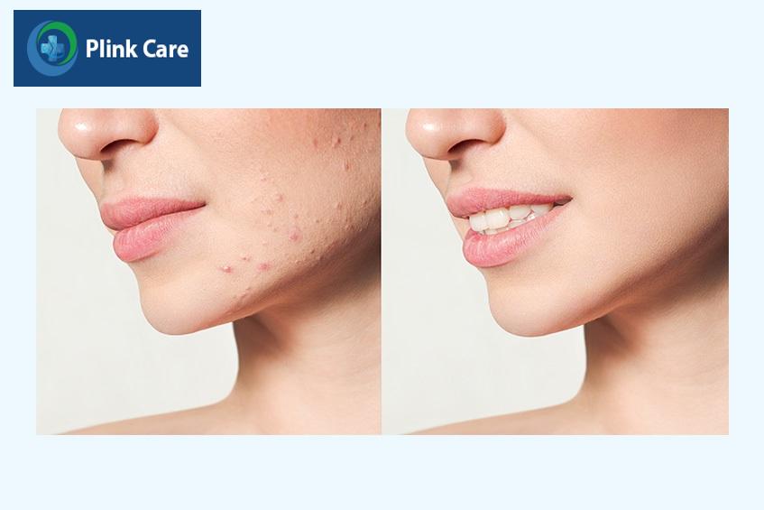 Mụn nội tiết ở quai hàm trước và sau điều trị