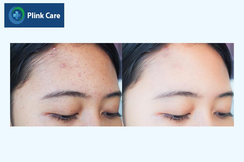 Mụn nội tiết ở trán lúc trước và sau khi điều trị