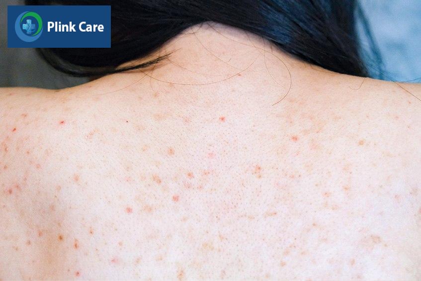 Mụn nội tiết ở vị trí lưng
