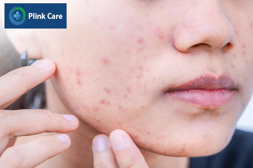 Mụn nội tiết ở vị trí má