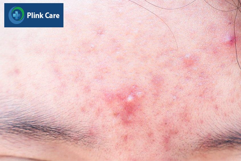 Mụn nội tiết ở vị trí trán