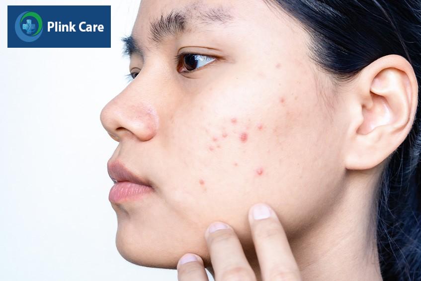 Mụn nội tiết ở vùng má