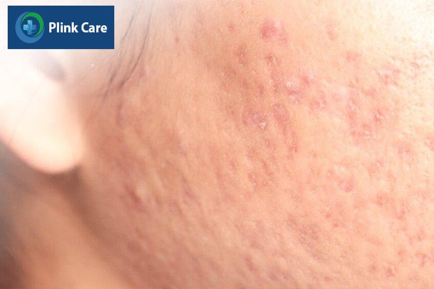 Nặn mụn không đúng cách rất dễ để lại sẹo