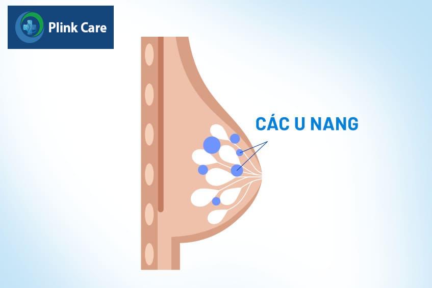 nang bọc sữa