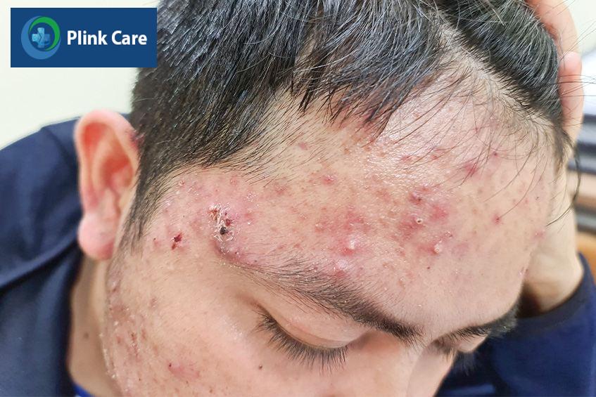 Người bệnh bị mụn nội tiết nặng