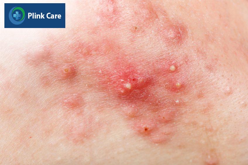 Mụn bọc không nhân xuất hiện do lỗ chân lông trên da tắc nghẽn, làm cho các tế bào chết, bụi bẩn, bã nhờn và vi khuẩn tích tụ trong lỗ chân lông
