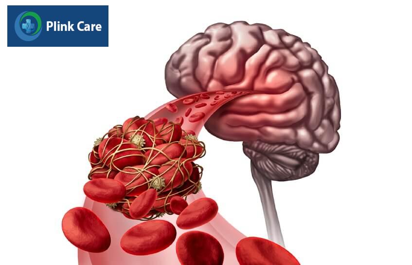 nguyên nhân thiếu máu não ở người già