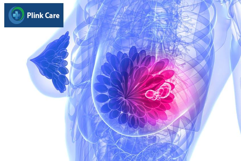 nguyên nhân u vú ở phụ nữ đang cho con bú