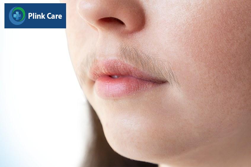Vùng mép và má thường xuất hiện các nang lông khỏe mạnh, sẫm màu do đó nên cân nhắc triệt lông tại vị trí này.