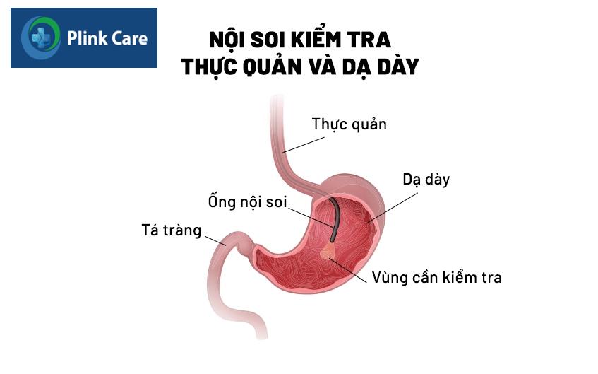 nội soi đường tiêu hóa trên