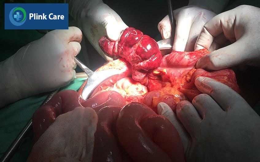 Phẫu thuật điều trị lồng ruột cấp
