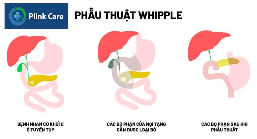 phẫu thuật whipple điều trị ung thư tuyến tụy