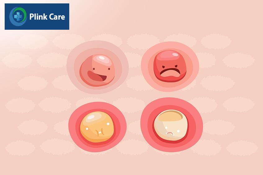Giảm nguy cơ mắc mụn bọc không nhân bằng cách vệ sinh da kỹ lưỡng
