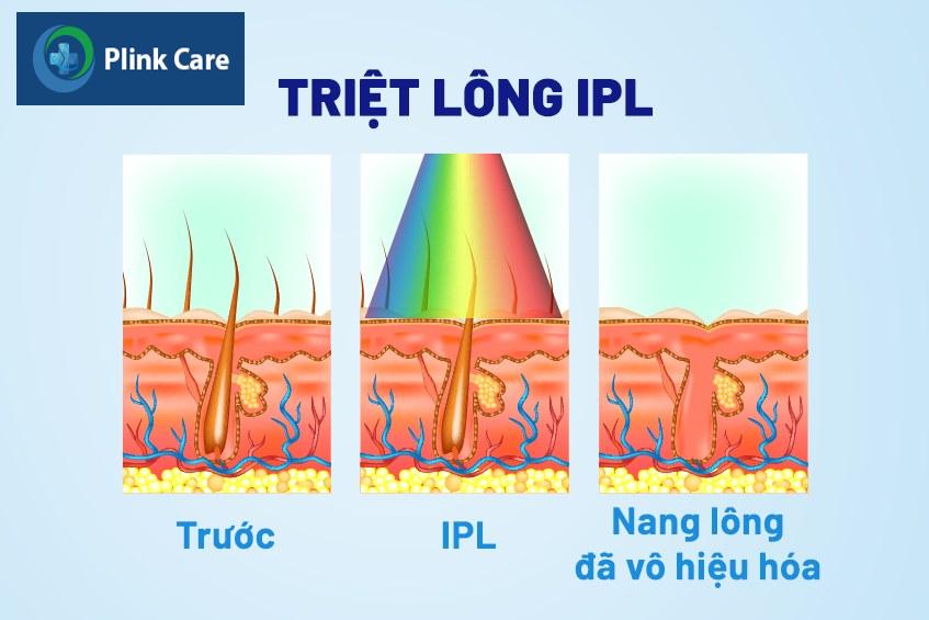 Công nghệ triệt lông mặt IPL tác động đến nang lông làm huỷ nang lông mà không ảnh hưởng vùng da xung quanh.
