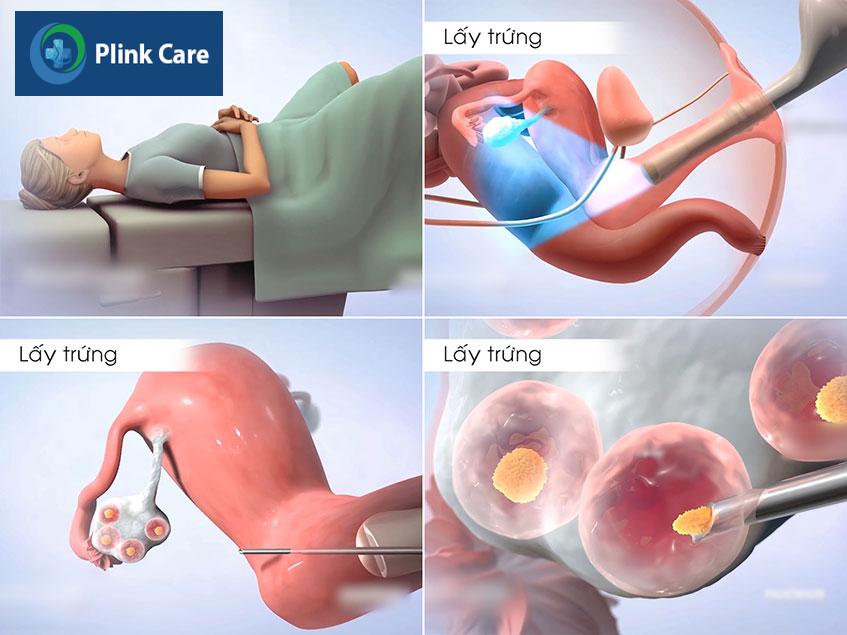 quy trình chọc hút noãn
