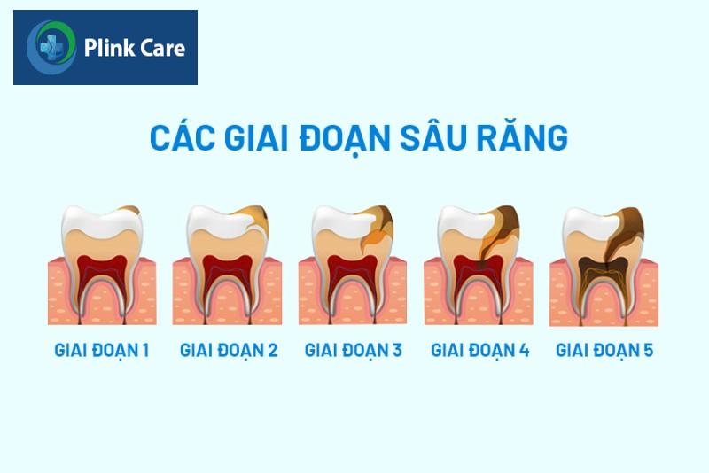 Các giai đoạn của sâu răng