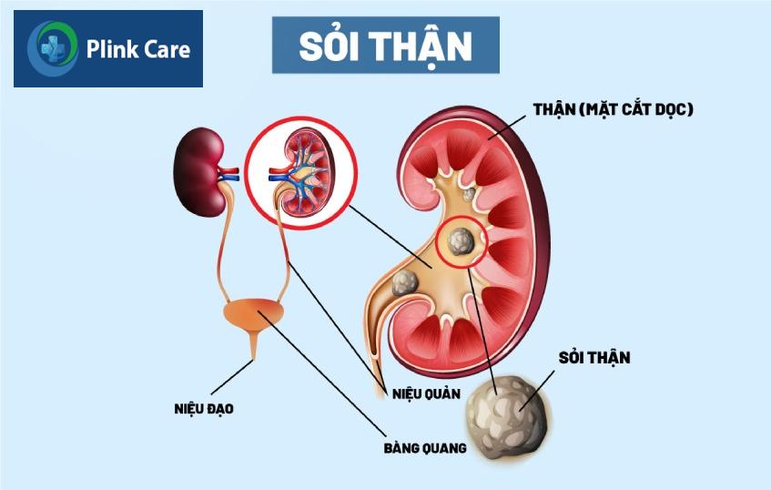 Sỏi thận là bệnh gì