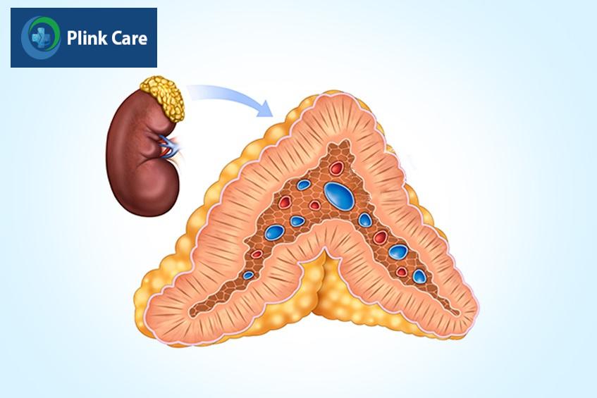 Suy thượng thận cấp tính xảy ra do không đủ cortisol