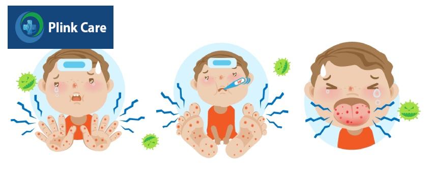 Tay chân miệng gây triệu chứng sốt và phát ban