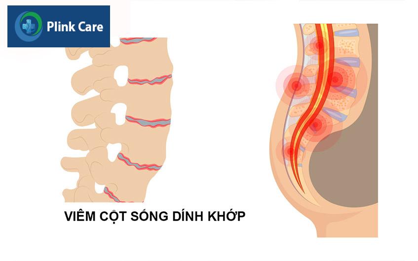 tình trạng viêm cột sống dính khớp