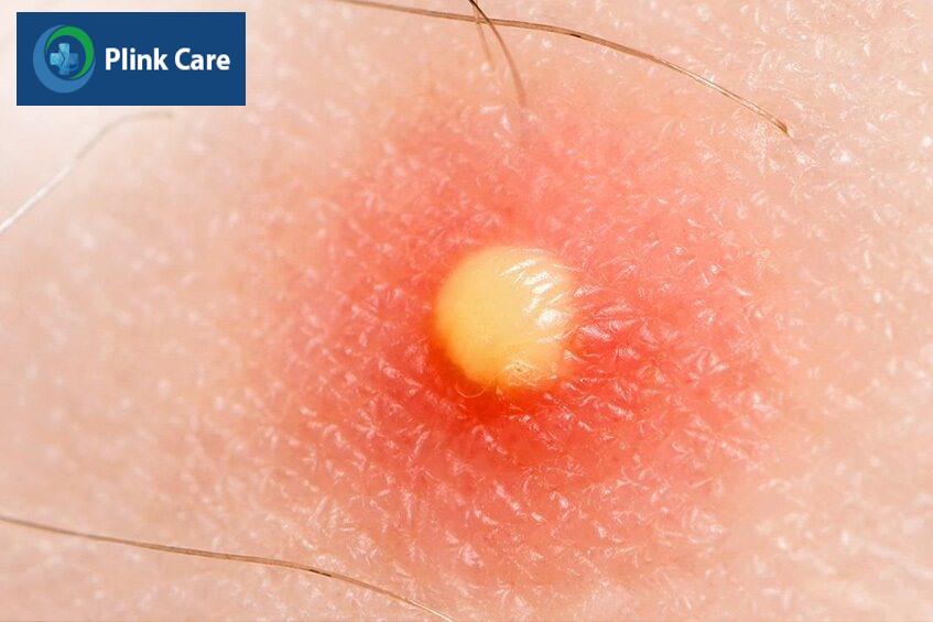 Mụn bọc là những vết sưng xuất hiện trên da có chứa máu hoặc mủ