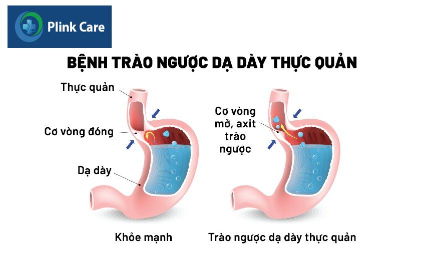 trào ngược dạ dày nghẹn cổ họng