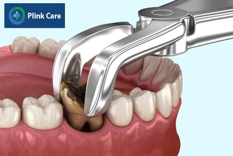 Trường hợp chỉ định nhổ răng