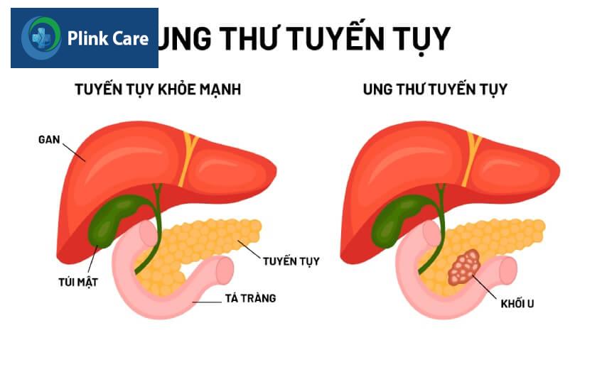tụy khỏe mạnh và ung thư tuyến tụy