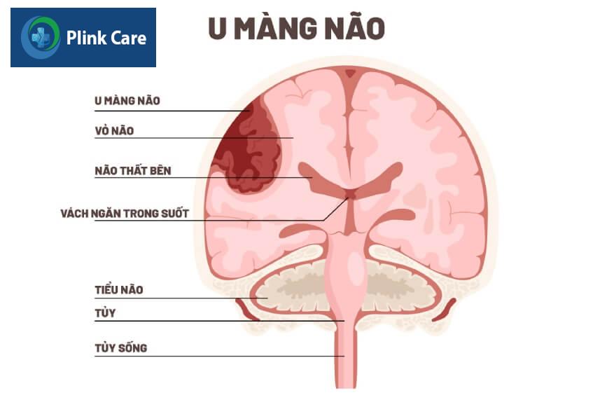 u màng não có nên mổ không